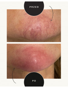 Zamykanie naczynek BRODA She Day Spa Warszawa Wilanów